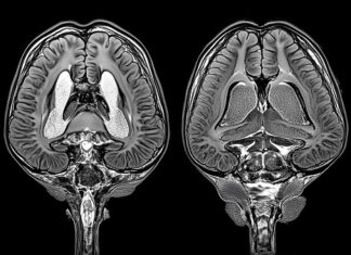 When you Don’t Sleep Well ! Your Brain Literally Begins Eating ITSELF